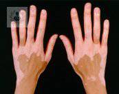 Vitiligo: qué es y cómo atenderlo (P1)