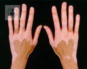 vitiligo-que-es-y-como-atenderlo-p1 imagen de artículo