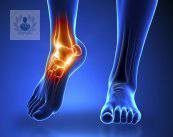 Lesiones de tobillo más frecuentes: esguince, fractura, luxación