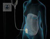 dialisis-peritoneal-renal imagen de artículo