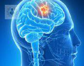 Tumor cerebral: signos y síntomas