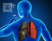 Cáncer de pulmón: cáncer con mayor mortalidad en el mundo (P1)