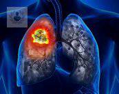 Cáncer de pulmón: cáncer con mayor mortalidad en el mundo (P2)