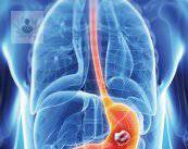 cancer-de-estomago-como-detectarlo imagen de artículo