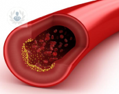 Cirugía de arteria carótida: cómo prevenir un accidente cardiovascular