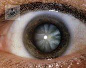 Cataracts: a simple cure that prevents blindness (P1)
