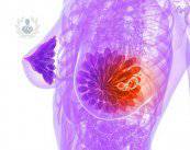 Mastografía: estudio ideal para detectar enfermedades mamarias (P2)