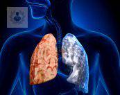 COPD: common condition in Mexico (P2)