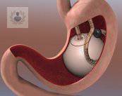 Balón intragástrico: tratamiento para obesidad y sobrepeso (P1)
