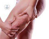 celulitis-lo-que-usted-tiene-que-saber imagen de artículo