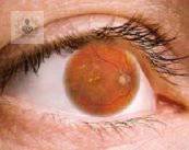 retinopatia-diabetica-consecuencias-de-altos-niveles-de-azucar imagen de artículo