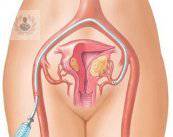 Miomas uterinos ¿Por que embolizarlos?