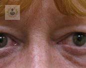 Orbitopatía tiroidea: una enfermedad ocular