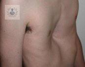 pecho-hundido-malformacion-toraxica-comun imagen de artículo