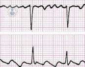 fibrilacion-auricular-la-arritmia-cardiaca-mas-comun imagen de artículo