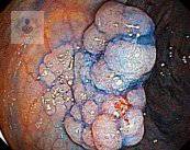 Polipectomía: tratamiento ideal para pólipos en el colon (P1)