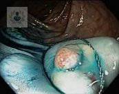 Polipectomía: tratamiento ideal para pólipos en el colon (P2)