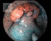 polipectomia-tratamiento-ideal-para-polipos-en-el-colon-p3 imagen de artículo