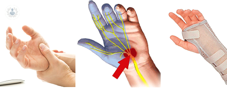 Síndrome del túnel carpiano: enfermedad progresiva de la mano