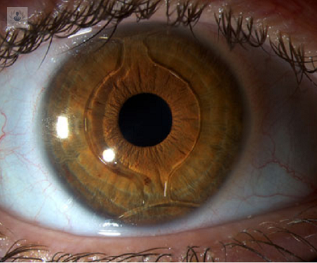 Lente intraocular fáquico: cirugía que permite dejar de usar lentes