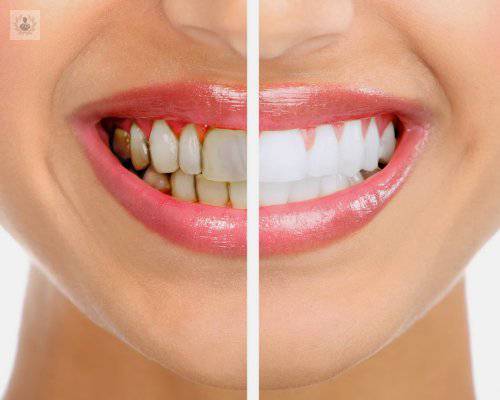 Periodoncia: tratamiento eficaz para la gingivitis y la periodontitis