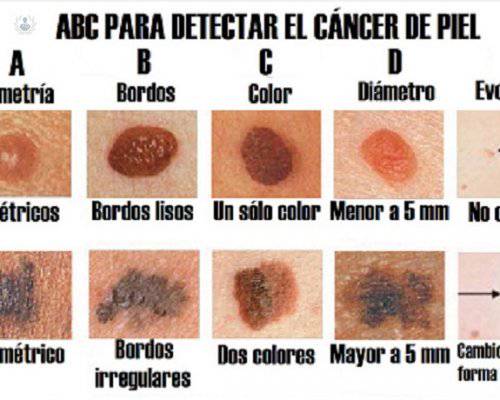 cancer-de-piel-protegete-en-estas-vacaciones imagen de artículo