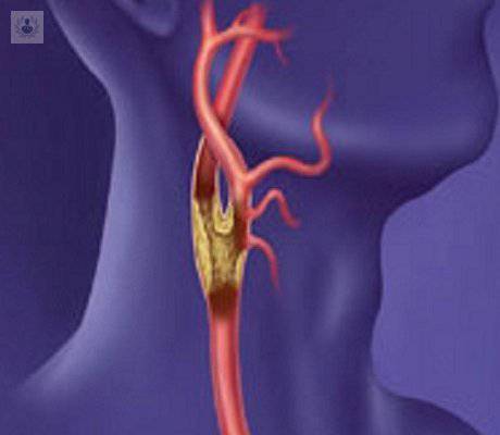 enfermedad-carotidea-prevencion-y-tratamiento imagen de artículo