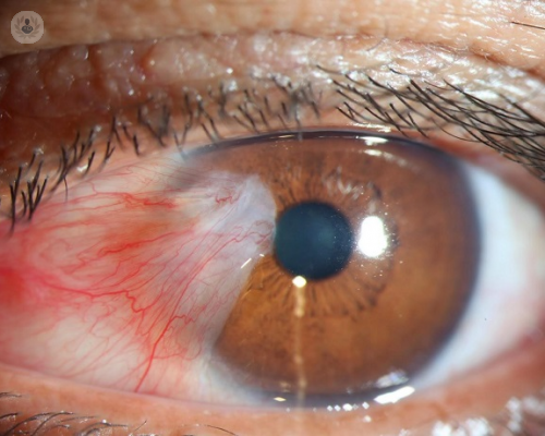 Pterigión o carnosidad: enfermedad que puede obstaculizar la visión