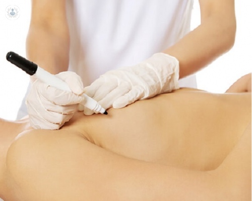 reconstruccion-mamaria-tecnicas-disponibles imagen de artículo