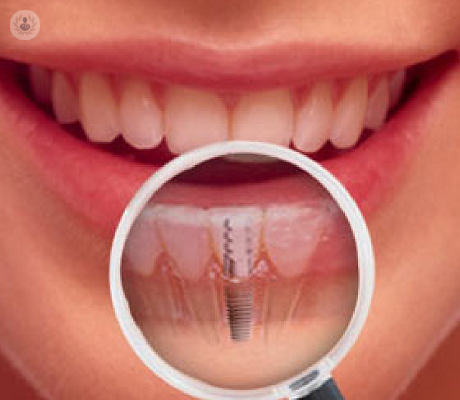 Implantes dentales: solución ideal ante la pérdida de una pieza dental