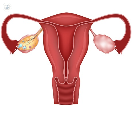 Endometriosis in women of reproductive age