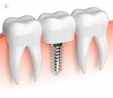 Mini implantes dentales: ventajas y desventajas