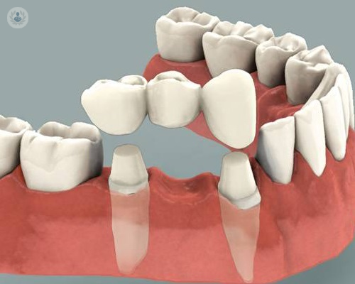 Puentes dentales: ¿cómo se hacen?