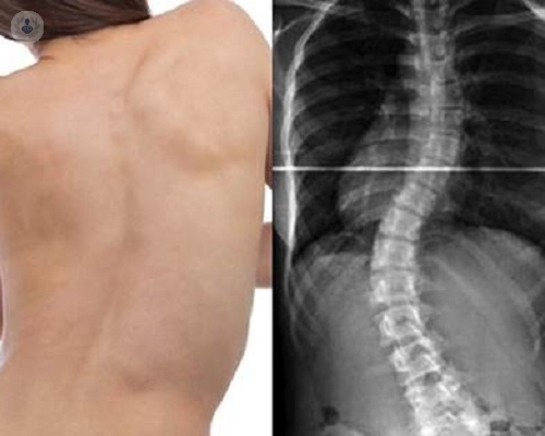 Escoliosis: curvatura anormal en la columna vertebral