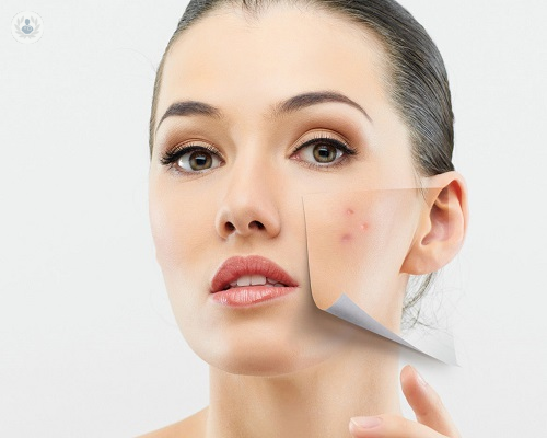 Marcas de acné: ¿cómo tratarlas?