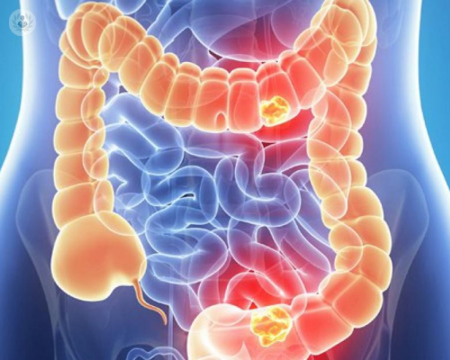 Cirugía de cáncer de colon: ¿cómo detectar la enfermedad a tiempo? (Parte 2)