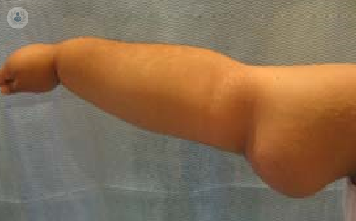 linfedema-principales-sintomas-y-tratamiento-parte-1 imagen de artículo