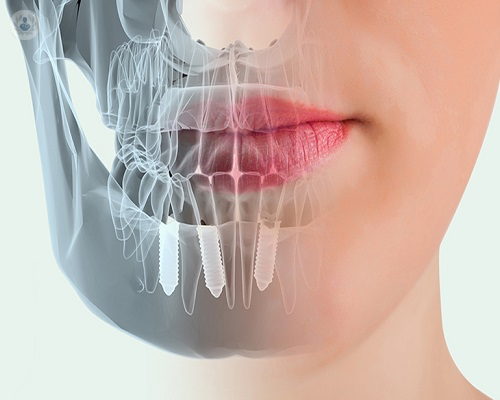 Implantes dentales: ¿qué son?