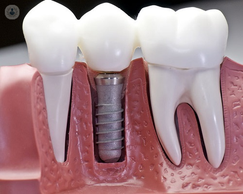 dientes-faltantes-como-se-pueden-sustituir-parte-1 imagen de artículo