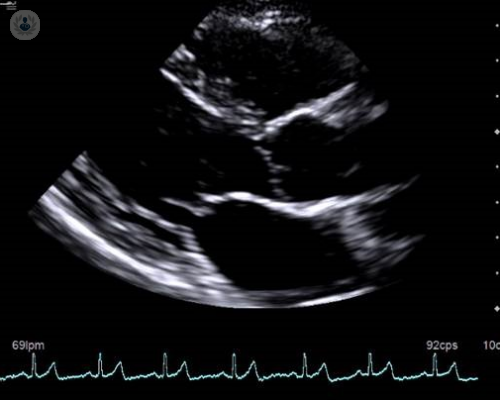 ¿Para qué casos se realiza un ecocardiograma?