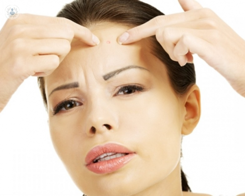 Conoce las causas del acné y evita que te afecte