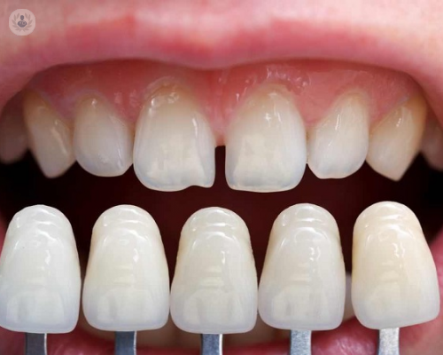 Mejora tus problemas dentales con carillas de porcelana