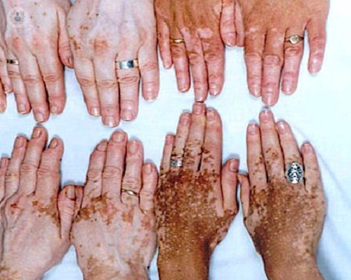 vitiligo-cuales-son-los-tratamientos-parte-2 imagen de artículo