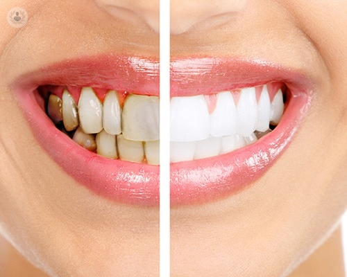 estetica-dental-tratamientos-disponibles-parte-2 imagen de artículo