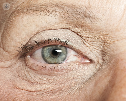 Glaucoma: enfermedad que puede provocar ceguera