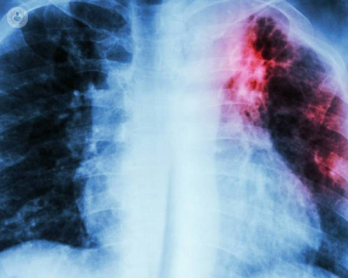 fibrosis-pulmonar-principales-signos-y-sintomas imagen de artículo