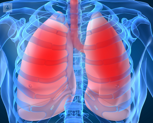 toracocentesis-diagnostico-y-tratamiento-para-el-derrame-pleural imagen de artículo