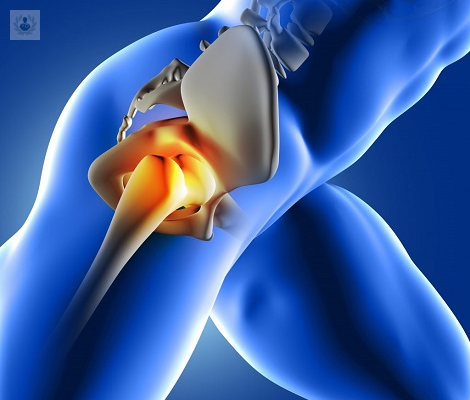 Cuidados de una prótesis de cadera