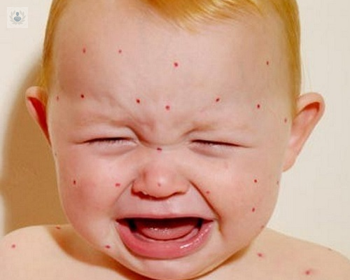 Síntomas de varicela: ¿cómo identificar esta enfermedad en niños?