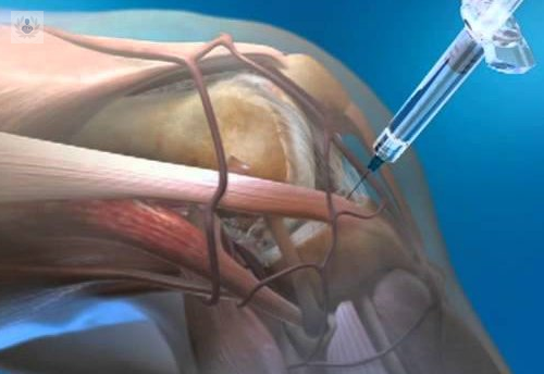 tratamiento-de-plasma-rico-en-plaquetas-y-de-celulas-madre-diferencias imagen de artículo